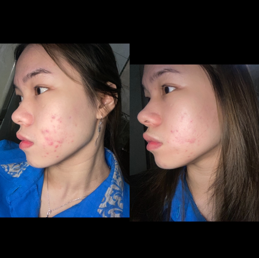elformula acne serum