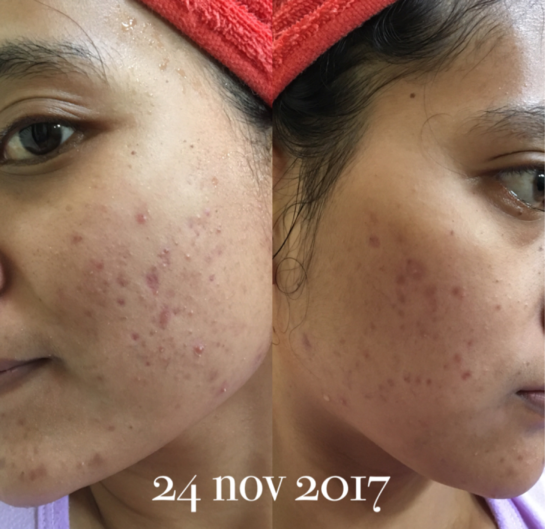 Kojie San Skin Lightening Soap Kojic Acid Review Female Daily