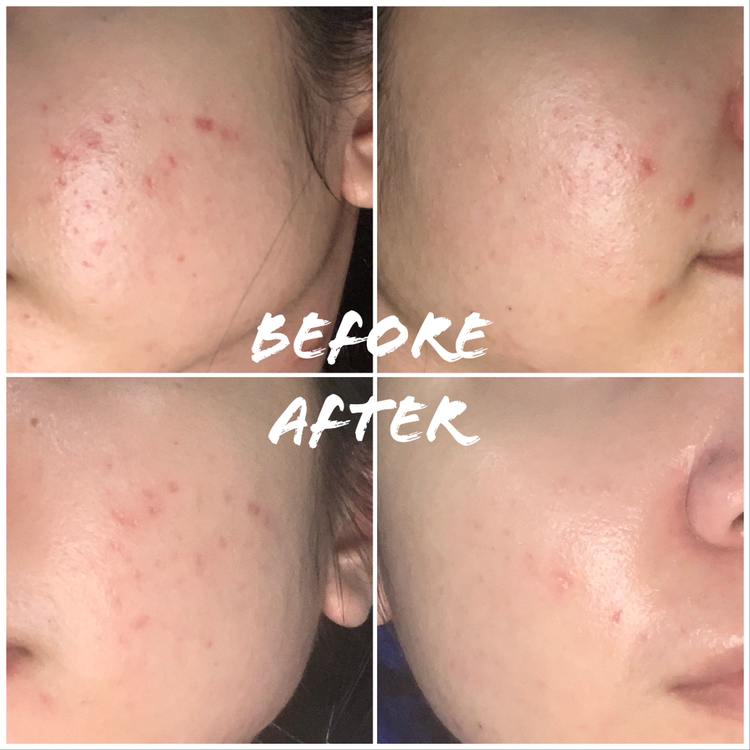 review pair acne cream