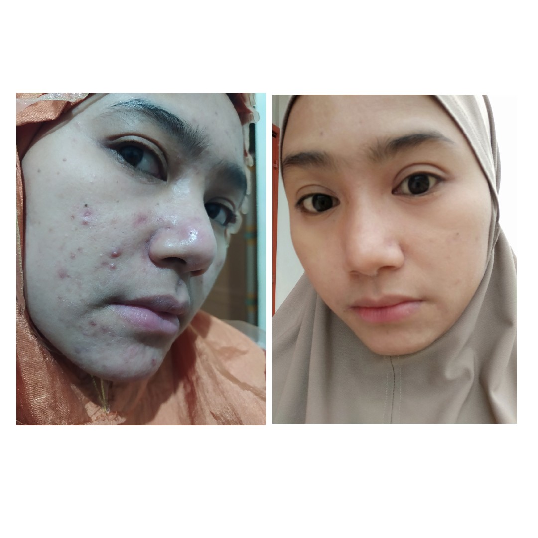 testimoni cetaphil
