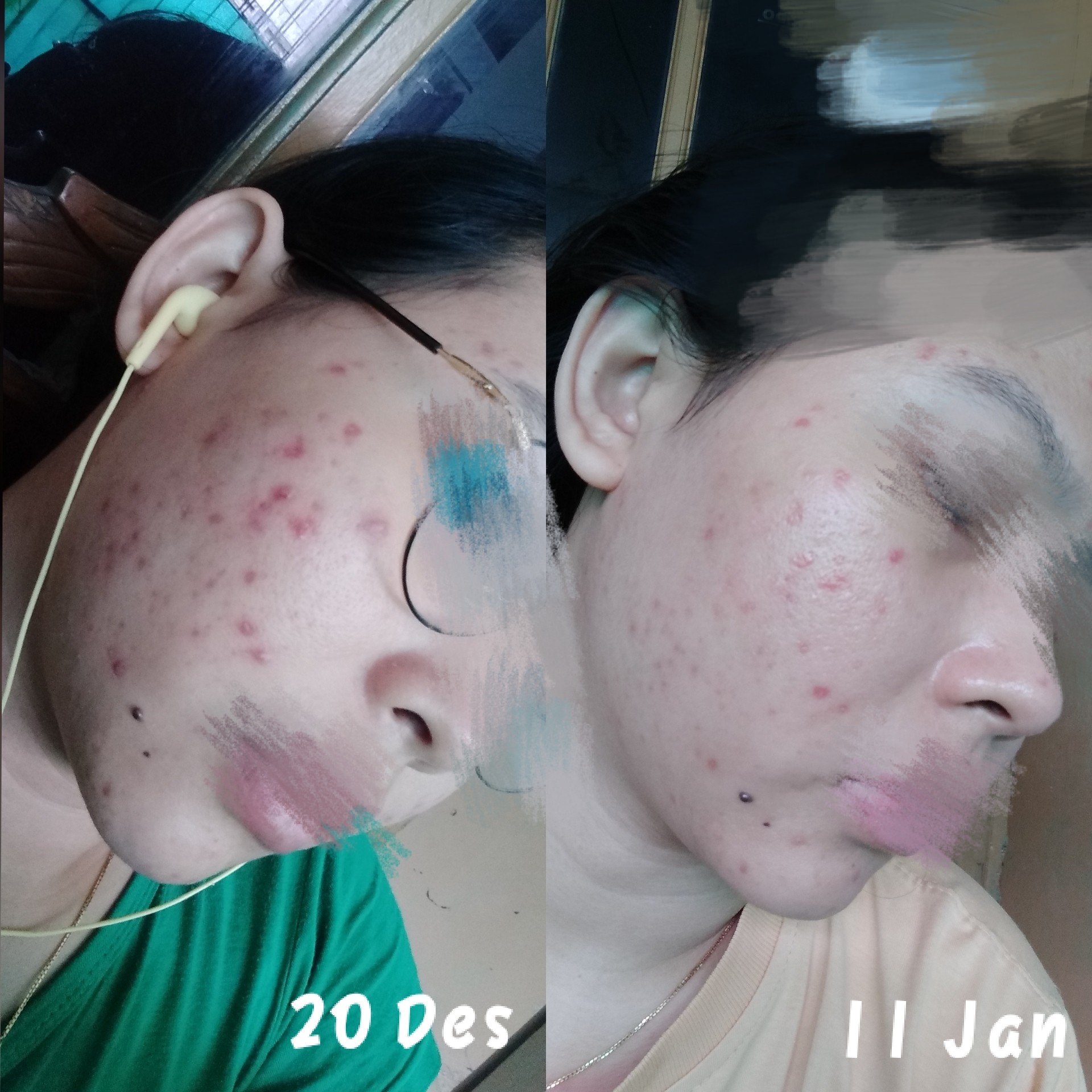 euclea acne blemish relief cream