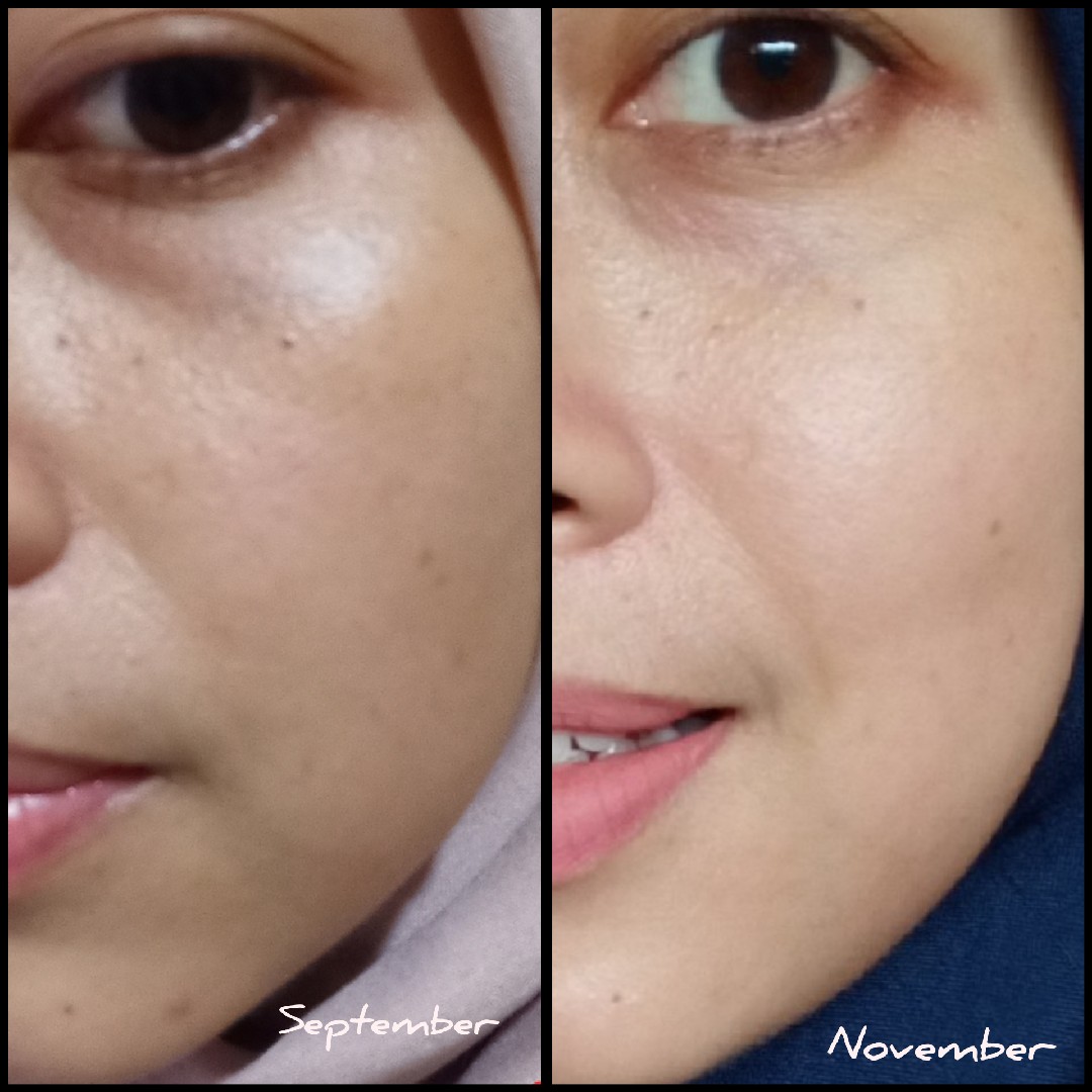 testimoni loreal white perfect