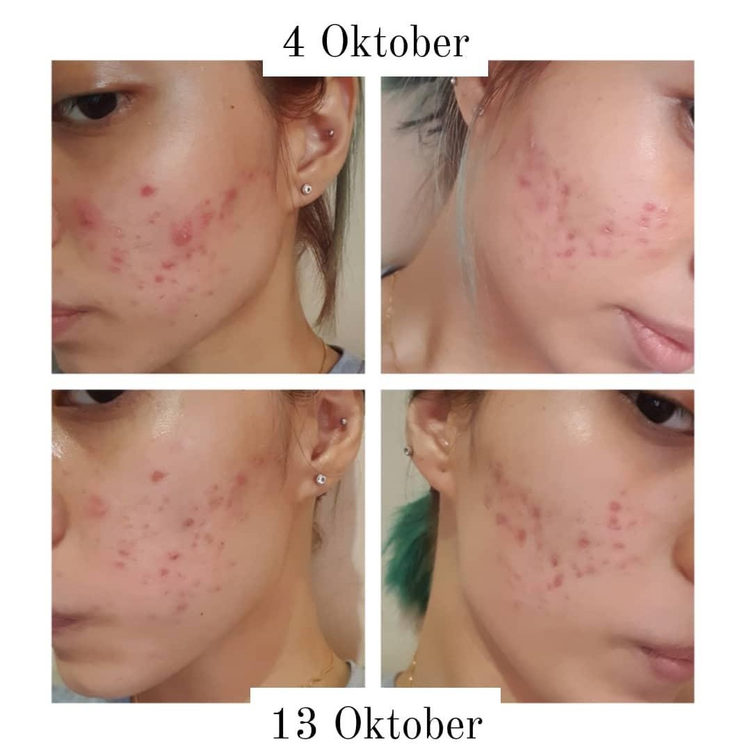 elformula acne serum