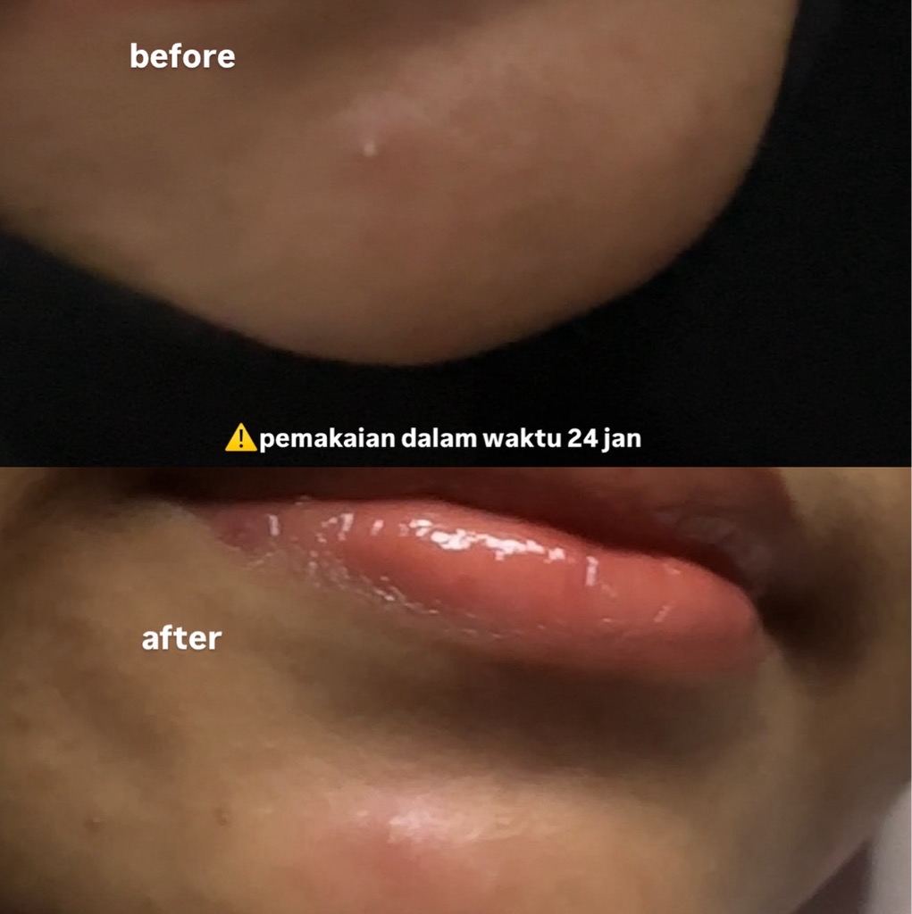 Acne Conclearing Spot Drying Lotion - Neutral imgfdn-04bdd532-6fb5-4dcd-a75a-47c2eaf41e82