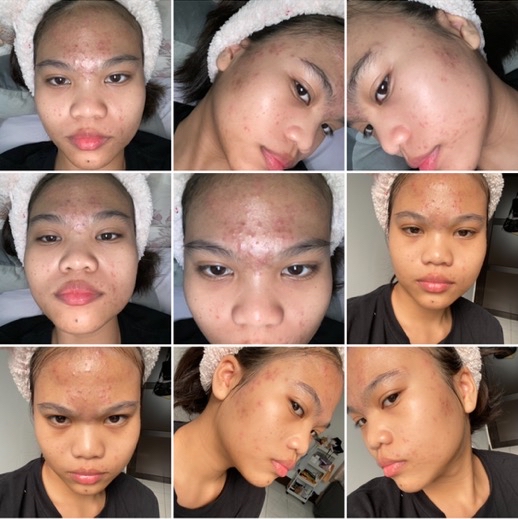 Gentle Acne Facial Wash imgfdn-ffadc6b3-4718-495e-852a-207f6cad7e38