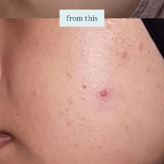 Centella Asiatica Acne Clear Hydrating & Calming Toner imgfdn-4c6caddf-61bf-4e31-adc3-152d2886e140