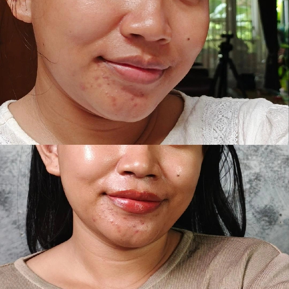 Exfoliating Mousse Solution 5% AHA + 2% BHA & PHA imgfdn-00e18356-8549-4e5f-a3b5-8fcd56213e6d