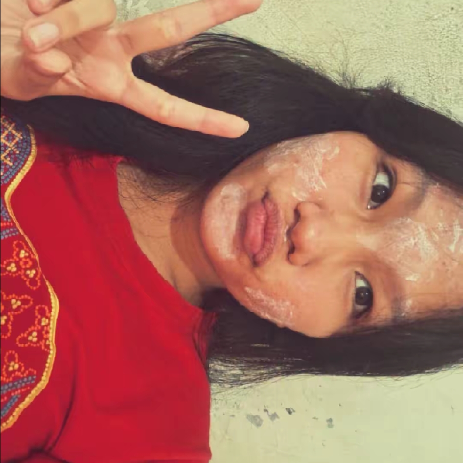 Acne Lotion imgfdn-9c17772e-793f-476d-9d77-0cca1c2a143d