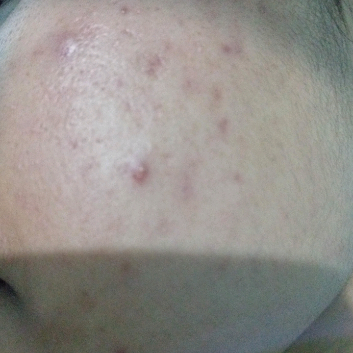 SPF50 PA++++ Acne & Oil Control imgfdn-23457390-7ed9-4796-b5ad-4df57d19d66f