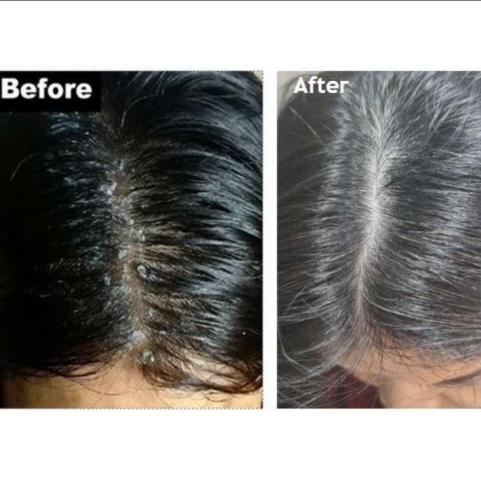 Gentle Moisturising Anti Dandruff Shampoo imgfdn-76f2a1d3-4e9e-4584-b9f2-3f55535f9925