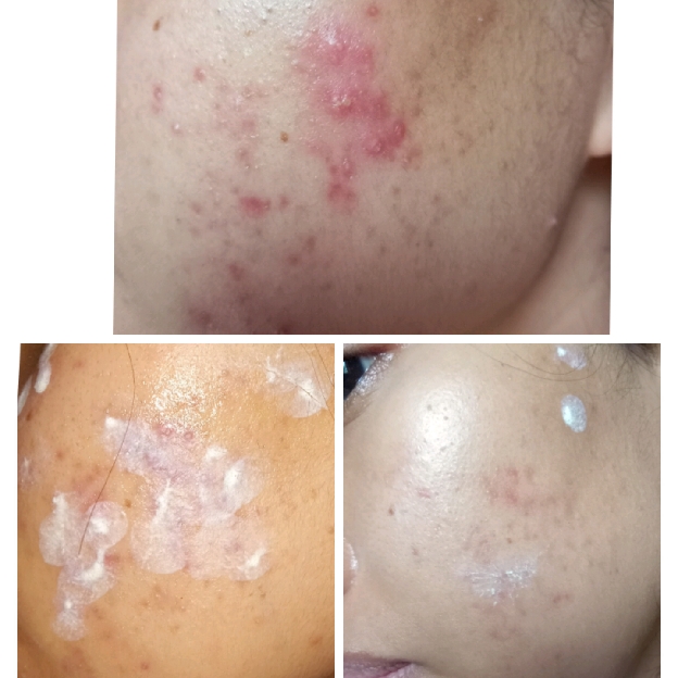 Acne Lotion imgfdn-7fd4d428-6f0d-4a6b-97cb-62d9eaba4dab