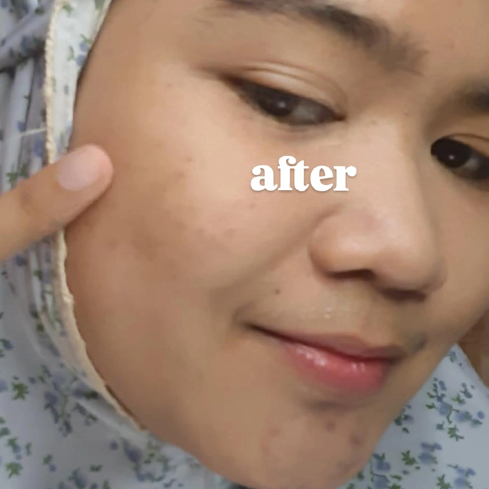 Low pH Acne Peace Gel Cleanser imgfdn-fa3b0fb4-df2d-4ec8-a540-88749aa12d34