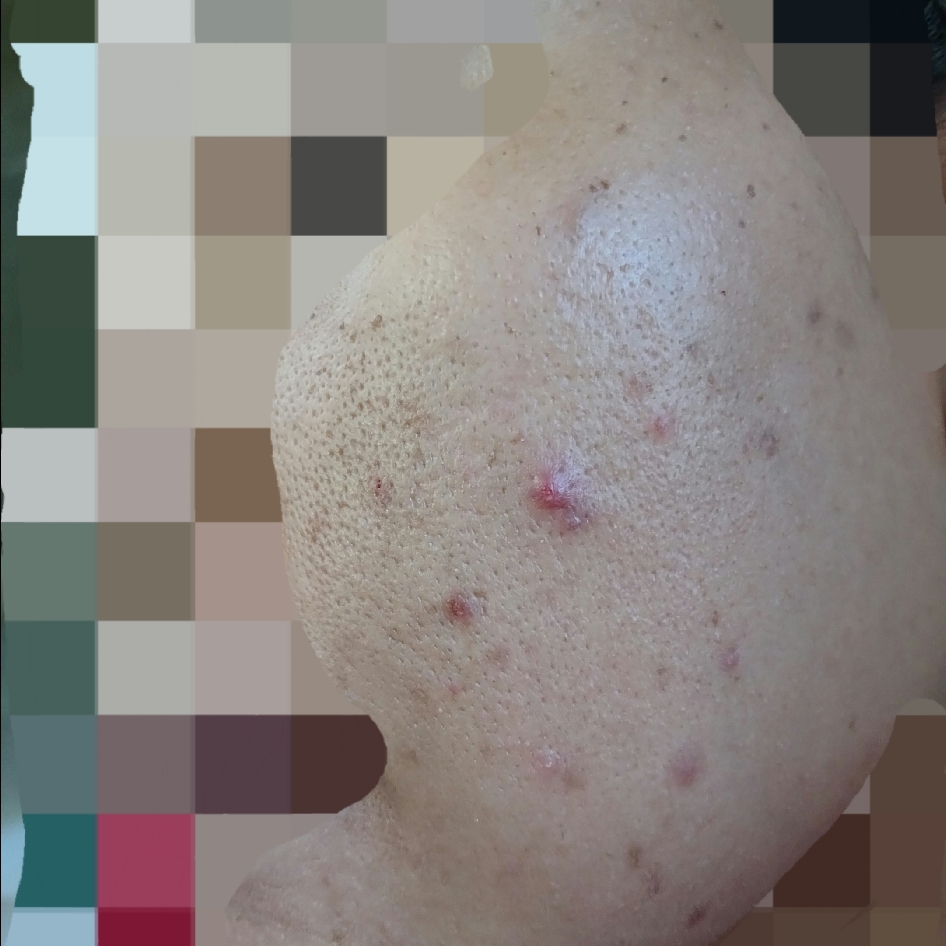 Acne Facial Cleanser imgfdn-9e58faa9-18ee-4507-8fa8-4d42846116f3