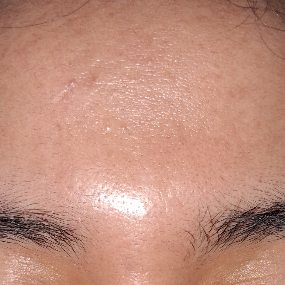Bye Bye Blackheads 30 Days Miracle Green Tea Tox imgfdn-ec17c547-a774-4a89-8a13-3f55622fd238