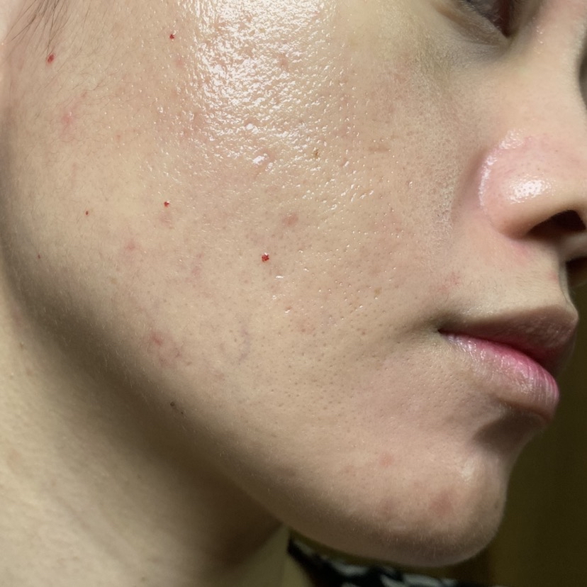 Acne Protect-Tea Spot Treatment imgfdn-c1132c5f-4daa-49f7-bc3b-6561e92491f2
