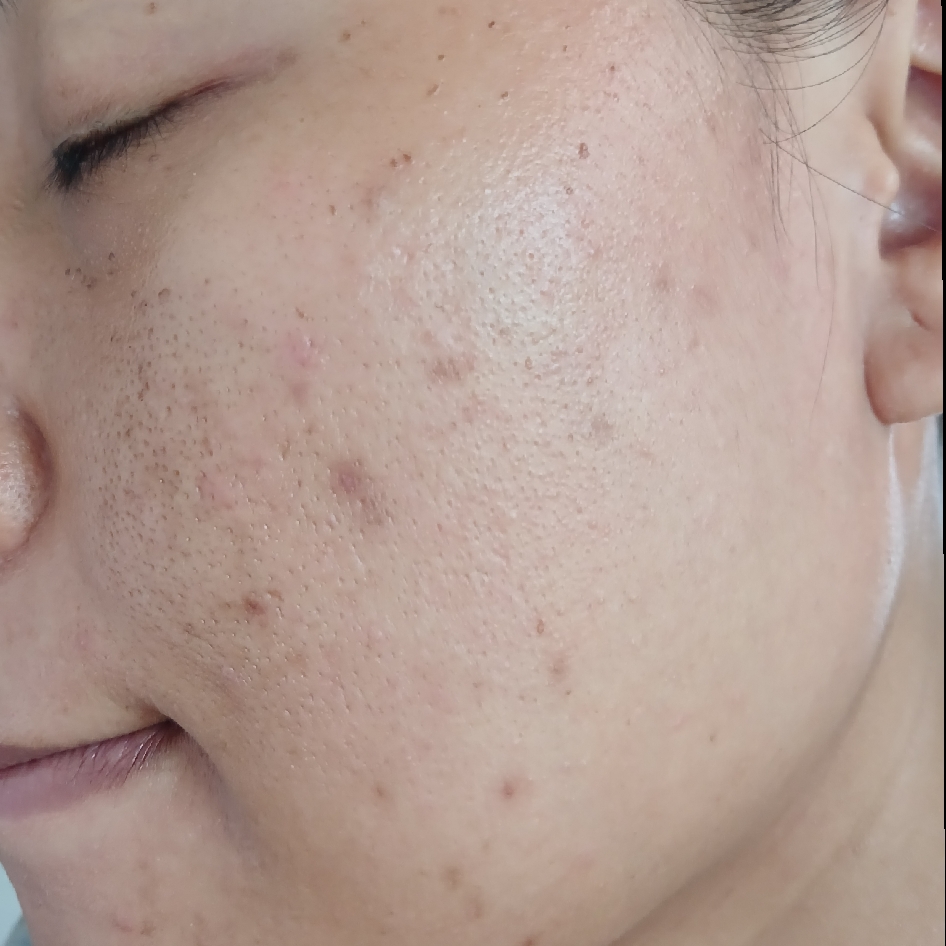 Acne Facial Cleanser imgfdn-c266d945-bb93-4e5a-83b4-9c715d386afd