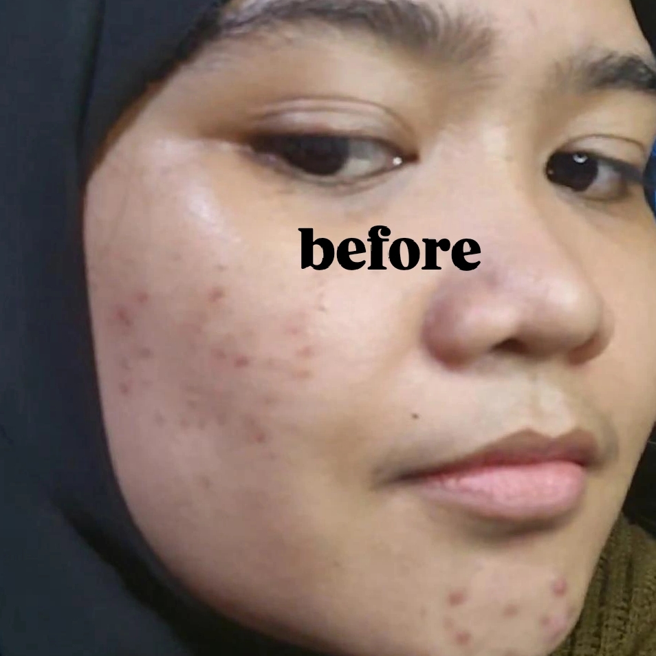 Low pH Acne Peace Gel Cleanser imgfdn-673bcaa8-c738-4ddf-8c6f-d204e82bd9be