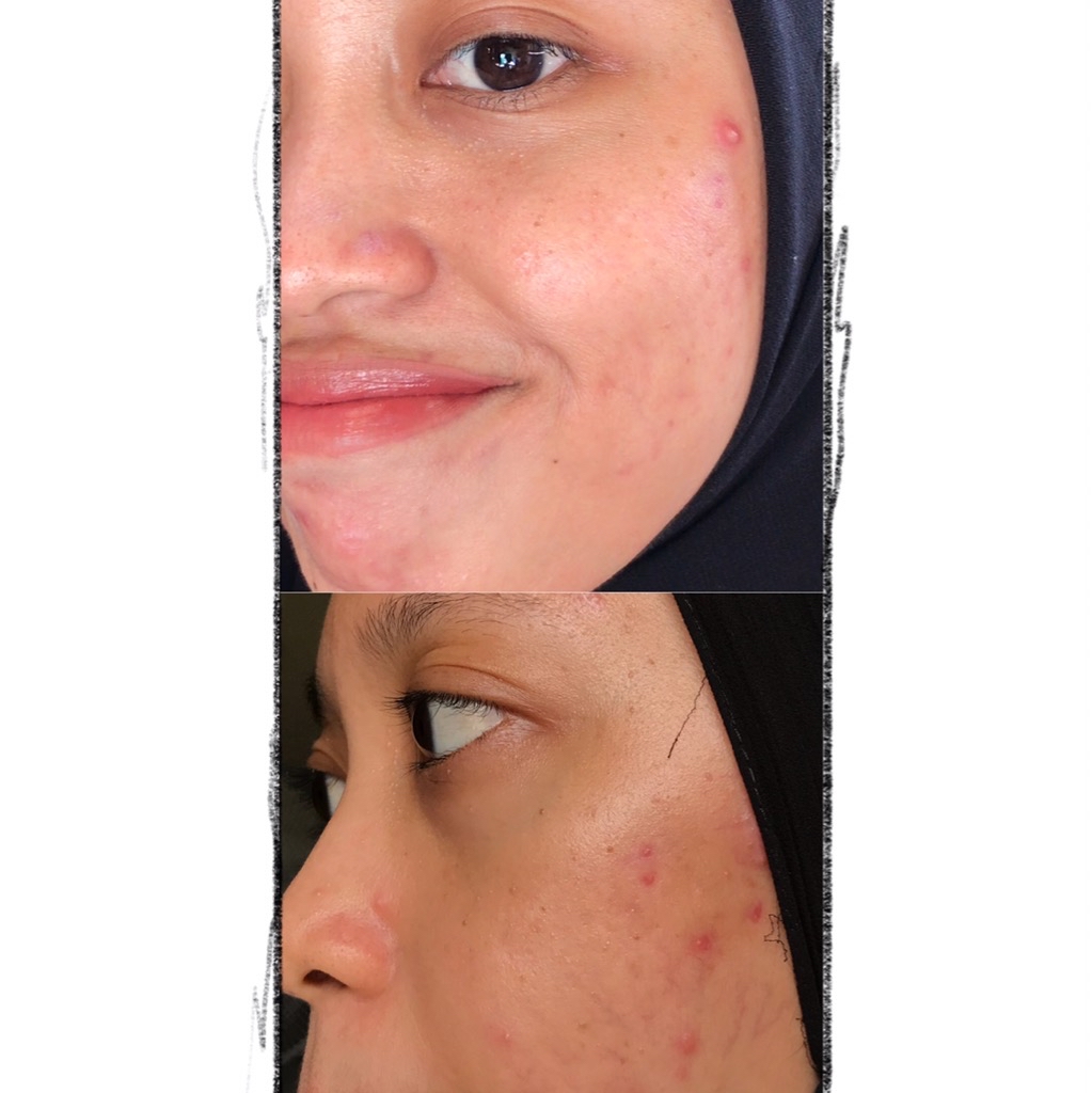 Acne Treatment Facial Oil Serum imgfdn-606a3100-58dc-4376-8328-3151c1e927b1