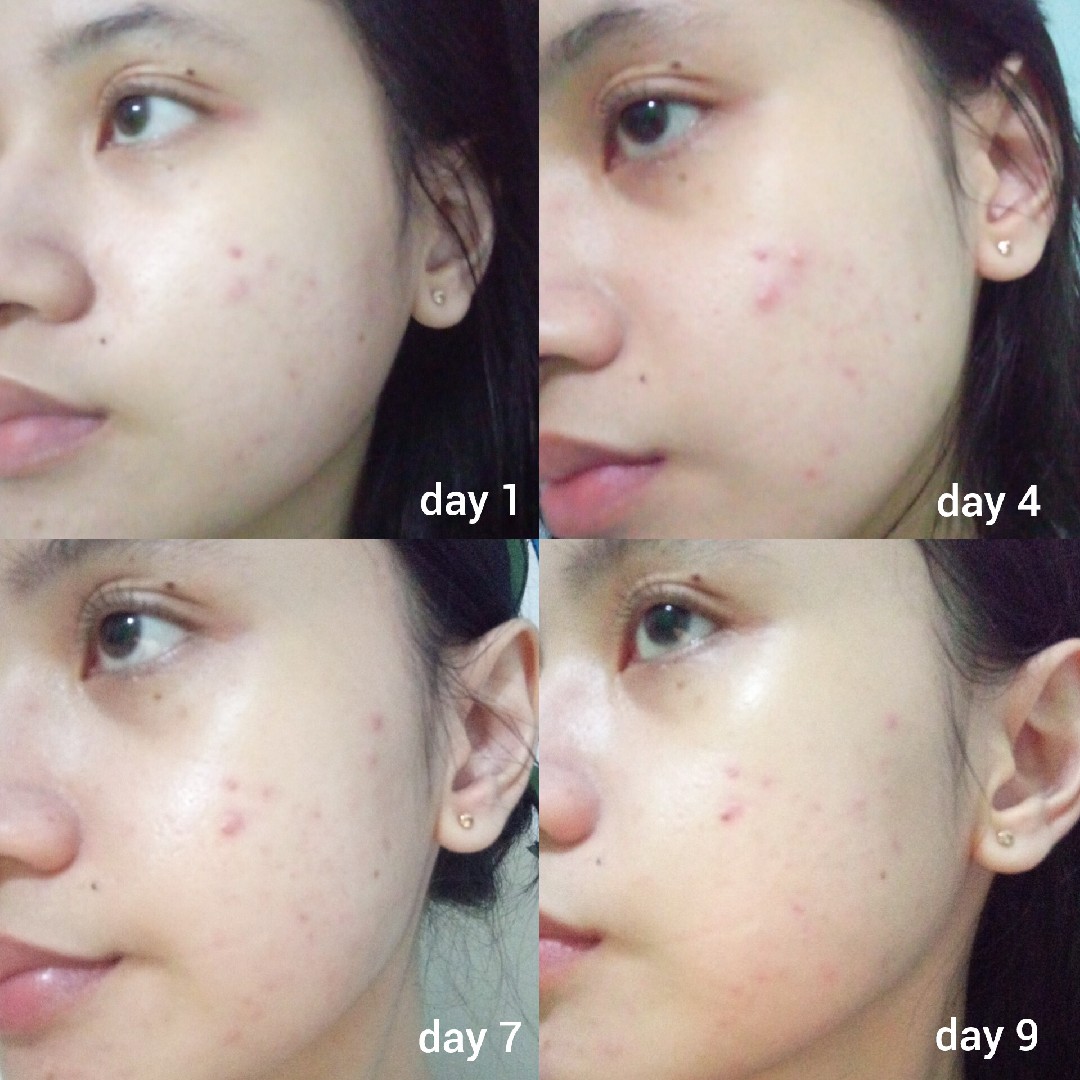 3X Acid Intensive Acne Spot imgfdn-5dd3e5c0-88ea-403a-a6aa-1cb629fbb954