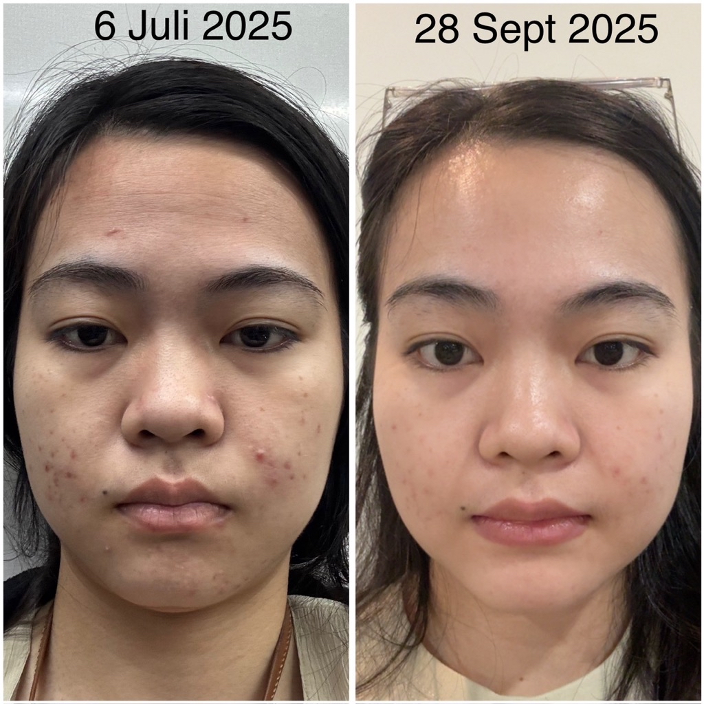 Acne Protection Sunscreen SPF 45 PA+++ - Reformulation in February 2023 imgfdn-8586bc38-e262-4592-913f-337291670794
