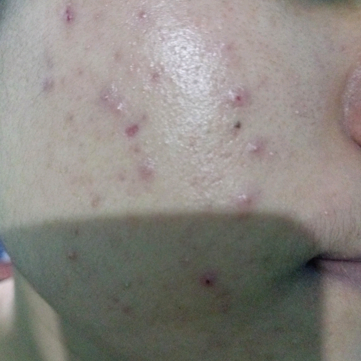 SPF50 PA++++ Acne & Oil Control imgfdn-d1b67e5f-ba85-4d89-ae3b-1a55dd42ebc4