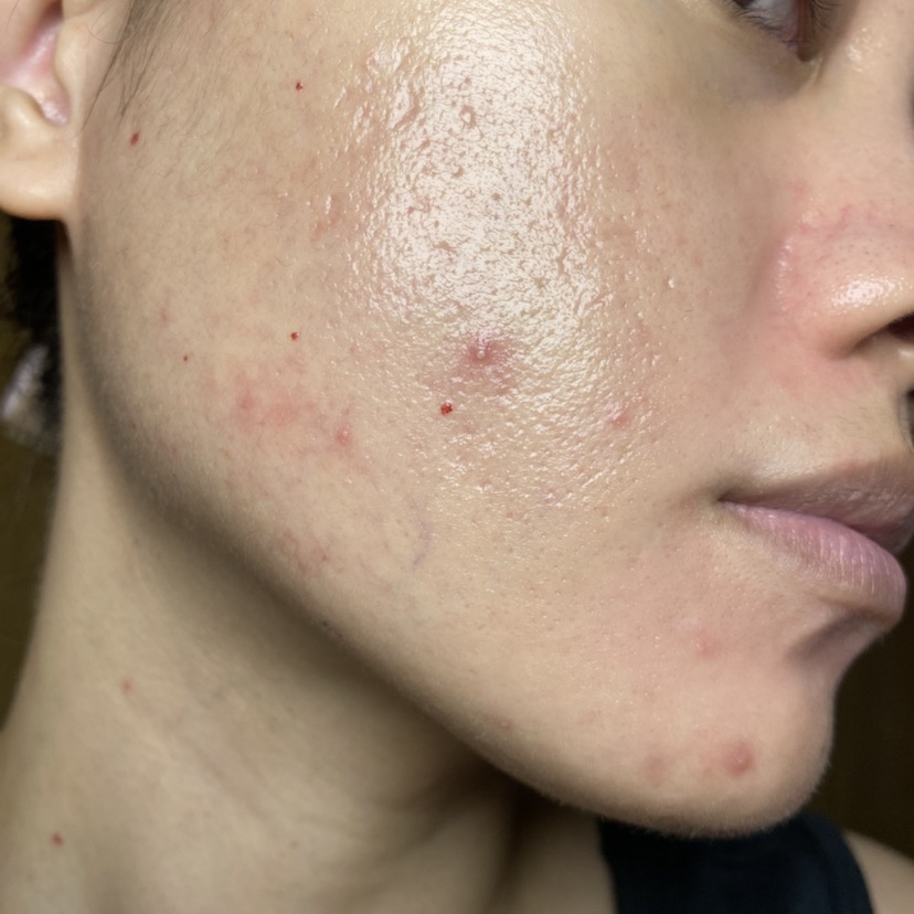 Acne Protect-Tea Spot Treatment imgfdn-23e9dc31-9091-4f21-9e29-5a8332153727