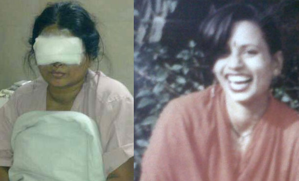 Anu Mukherjee, acid attack survivor (Photo: Facebook) Anu Mukherjee, acid attack survivor (Photo: Facebook)