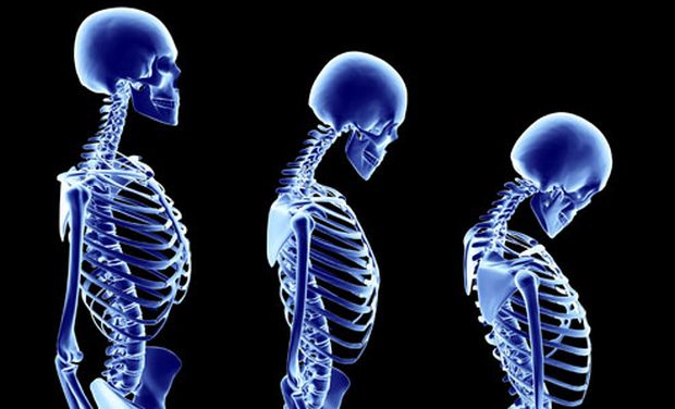 Stages of osteoporosis (Picture Courtesy: webmd.com) Stages of osteoporosis (Picture Courtesy: webmd.com)