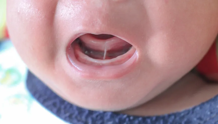 What Is Tongue-Tie