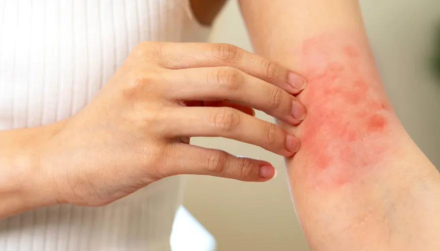 What are the complications that may occur due to dry skin in winter