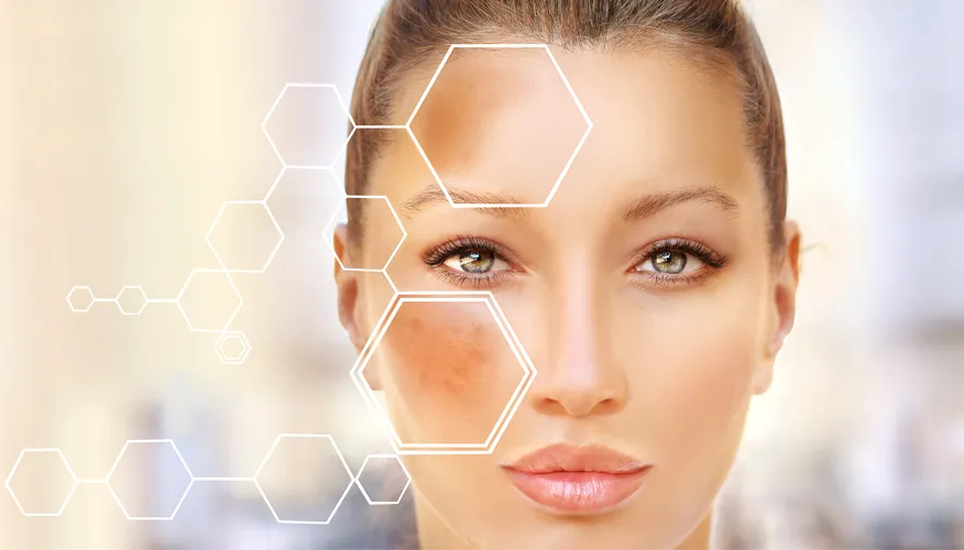  Hyperpigmentation and Dark Spots