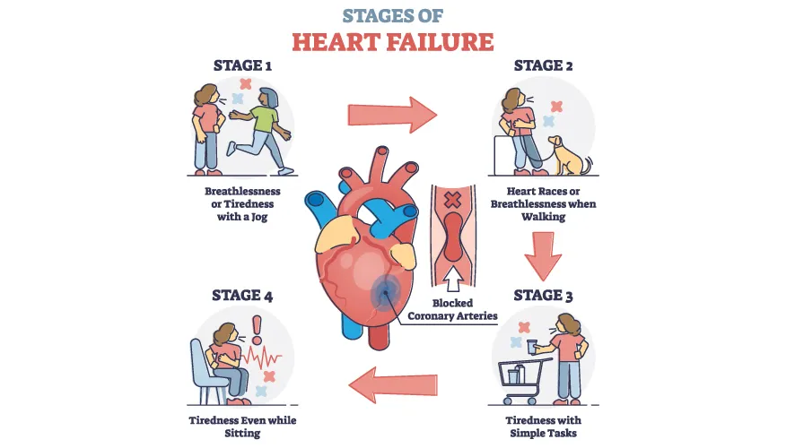 What are the Stages of Heart Failure?
