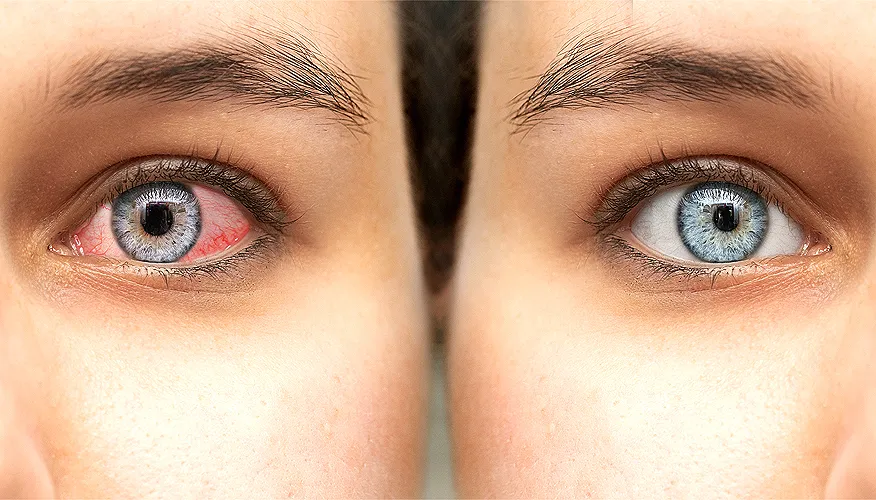What are gritty eyes?