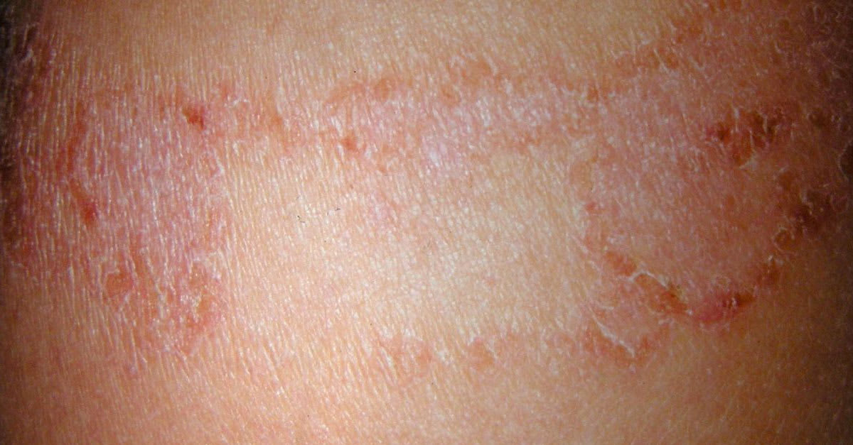 7 Best Soaps for EczemaProne Skin in Malaysia 2019 For Babies & Adults