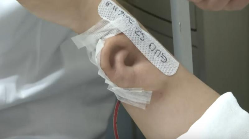 The patient, Mr. Ji was involved in a serious accident in 2015 and had undergone several surgeries to repair his facial skin and cheeks. (Photo: Youtube)