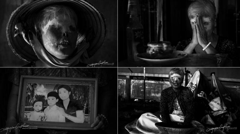 Photos show plight of an acid attack victim in Vietnam