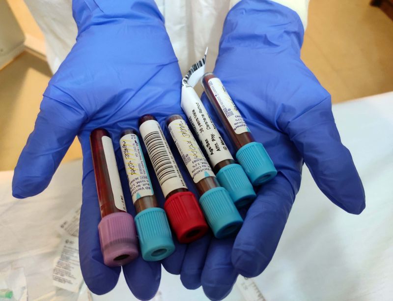 Kidney Ailments: Testing of Biomarkers To Check Vulnerability at Uddanam Kidney Ailments: Testing of Biomarkers To Check Vulnerability at Uddanam