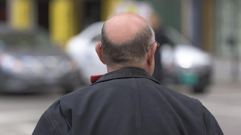 Balding also makes heart disease a little more complicated as the genes that reduce the risk were found along with thos that increase the risk. (Photo: Pixabay) Balding also makes heart disease a little more complicated as the genes that reduce the risk were found along with thos that increase the risk. (Photo: Pixabay)