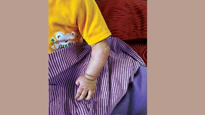 The infant’s left arm after surgery The infant’s left arm after surgery