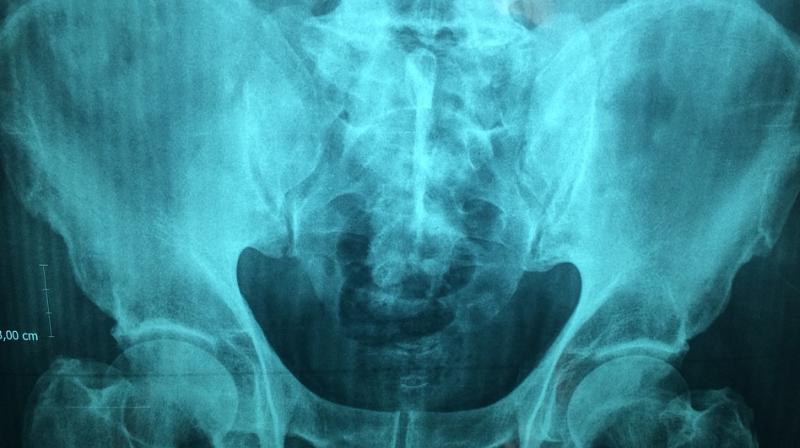 Total hip replacement is one of the most common elective operations. (Photo: Pixabay) Total hip replacement is one of the most common elective operations. (Photo: Pixabay)