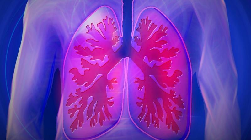 Small cell lung cancer is one of the most aggressive types of cancer. (Photo:Representational/Pixabay) Small cell lung cancer is one of the most aggressive types of cancer. (Photo:Representational/Pixabay)