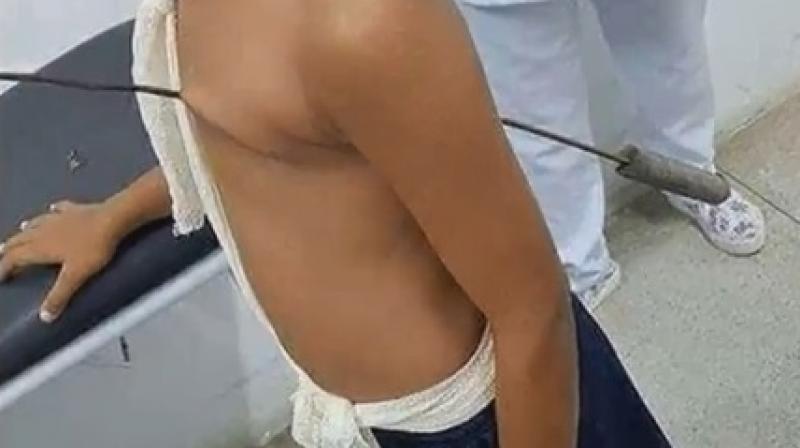 They said that not removing the skewer actually allowed the boy to survive for such a long time (Photo: YouTube) They said that not removing the skewer actually allowed the boy to survive for such a long time (Photo: YouTube)