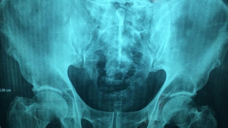 Five out of the seven studies linked low vitamin D levels to an increased risk of bladder cancer. (Photo: Pixabay) Five out of the seven studies linked low vitamin D levels to an increased risk of bladder cancer. (Photo: Pixabay)