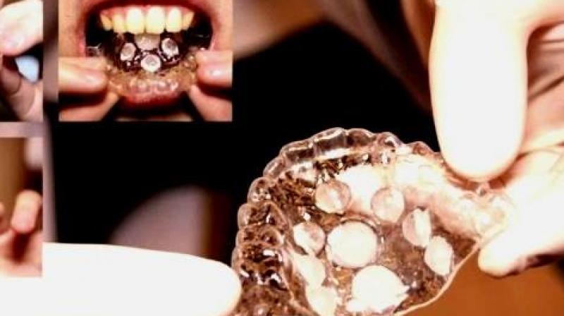 Dental retainers could change the way people experience oral sex. (Credit: YouTube) Dental retainers could change the way people experience oral sex. (Credit: YouTube)