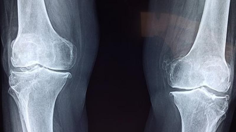 The longer the disease remains untreated, the greater is the damage. (Photo: Representational/Pixabay) The longer the disease remains untreated, the greater is the damage. (Photo: Representational/Pixabay)