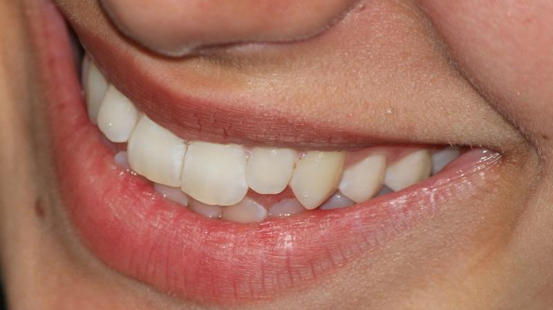 We can never rid the mouth of bacteria altogether, but good oral hygiene can limit the quantities of bacteria present. (Photo: Pixabay) We can never rid the mouth of bacteria altogether, but good oral hygiene can limit the quantities of bacteria present. (Photo: Pixabay)