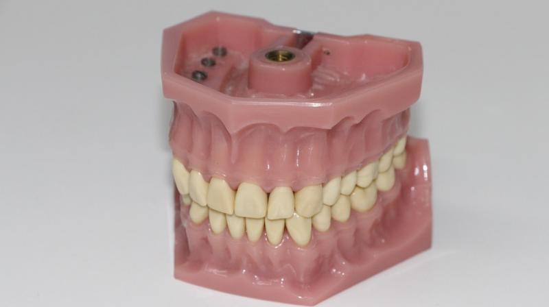 Chronic mucosal irritation resulting from ill-fitting dentures may be considered a risk factor for the development of oral cancer. (Photo: Pixabay) Chronic mucosal irritation resulting from ill-fitting dentures may be considered a risk factor for the development of oral cancer. (Photo: Pixabay)