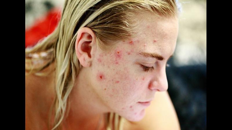 The results indicate that it is critical that physicians monitor mood symptoms in patients with acne. (Photo: ANI) The results indicate that it is critical that physicians monitor mood symptoms in patients with acne. (Photo: ANI)