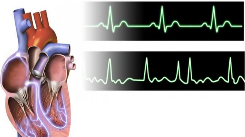 Height, and genetic variants associated with height, are strongly associated with an increased risk of AFib, independent from traditional clinical and echocardiographic risk factors. (Photo: ANI) Height, and genetic variants associated with height, are strongly associated with an increased risk of AFib, independent from traditional clinical and echocardiographic risk factors. (Photo: ANI)
