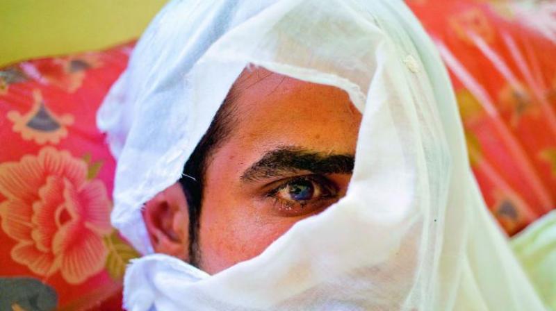 A youth whose eye was damaged after forces fired pellets at him in Srinagar. A youth whose eye was damaged after forces fired pellets at him in Srinagar.